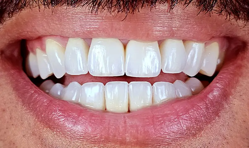إعادة تأهيل الابتسامة After