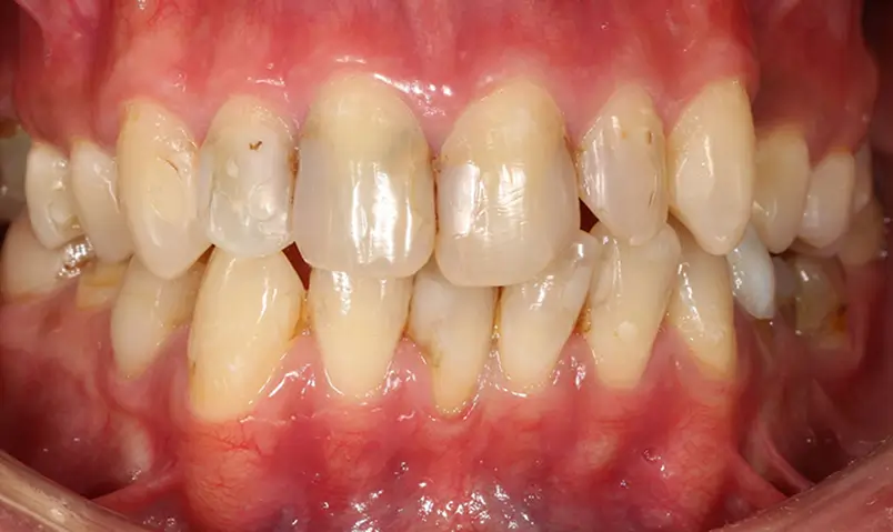 إعادة تأهيل الابتسامة Before